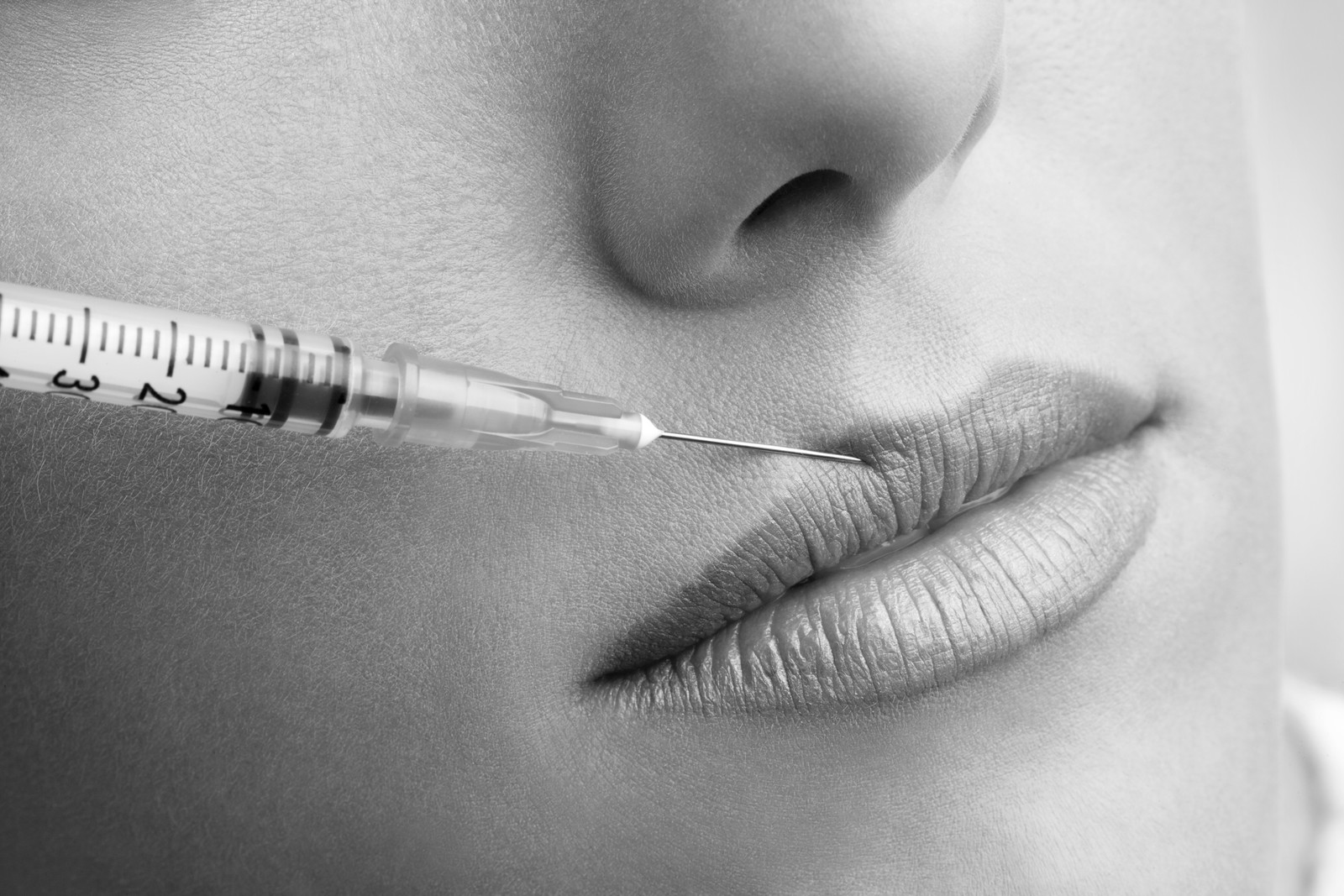 Natürlicher Lippenaufbau - Die Vorteile natürlicher Unterspritzung der Lippen